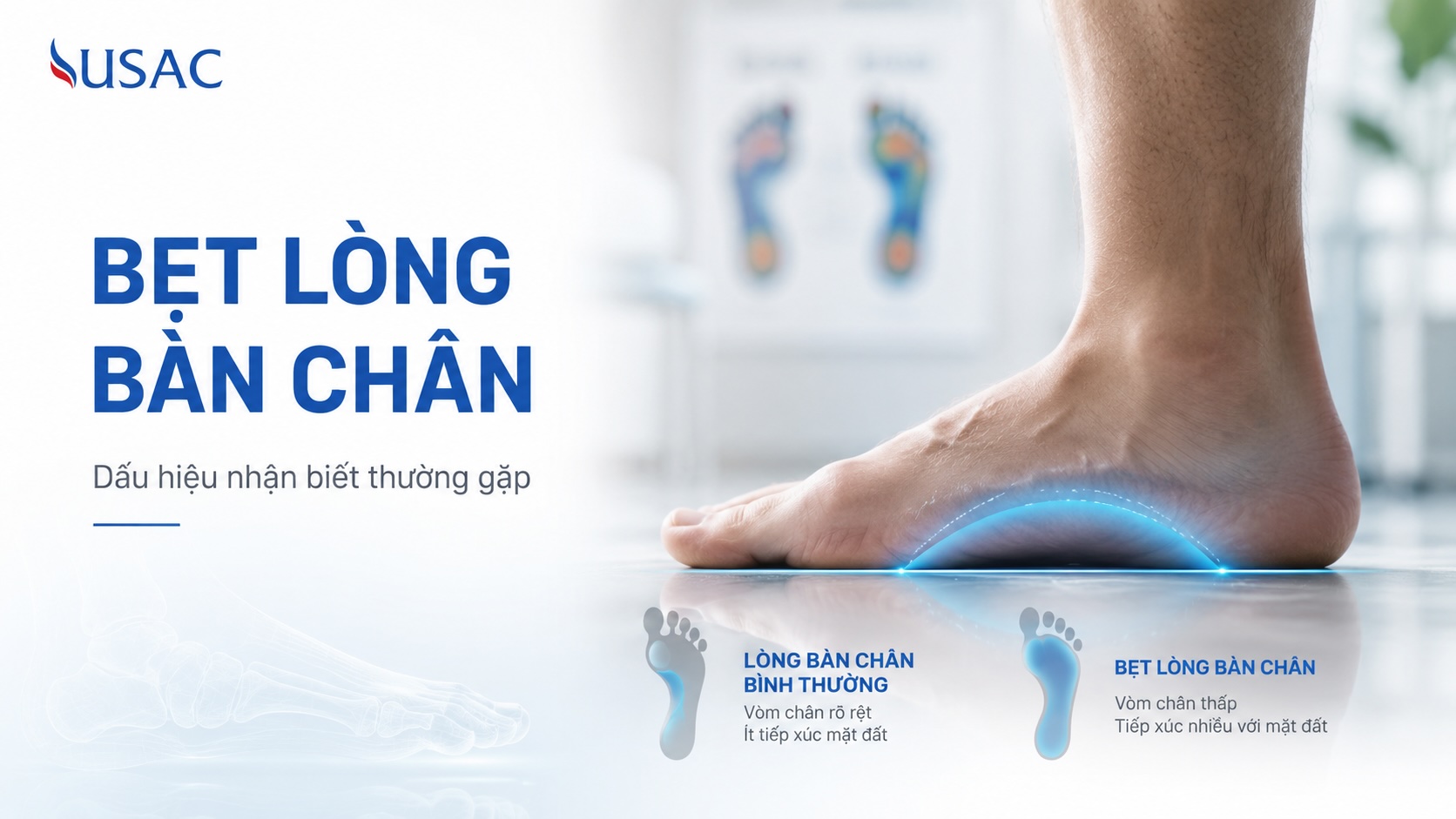 Bẹt Lòng Bàn Chân Bẹt Lòng Bàn Chân