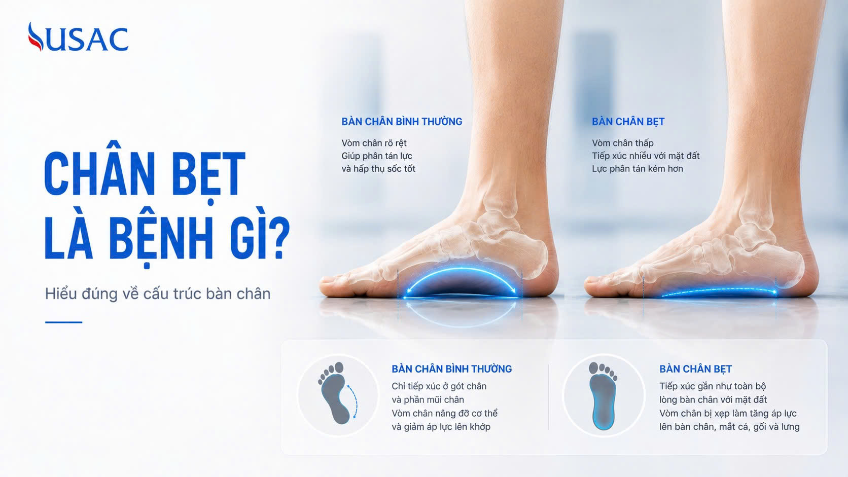 Chân Bẹt Là Bệnh Gì Chân Bẹt Là Bệnh Gì