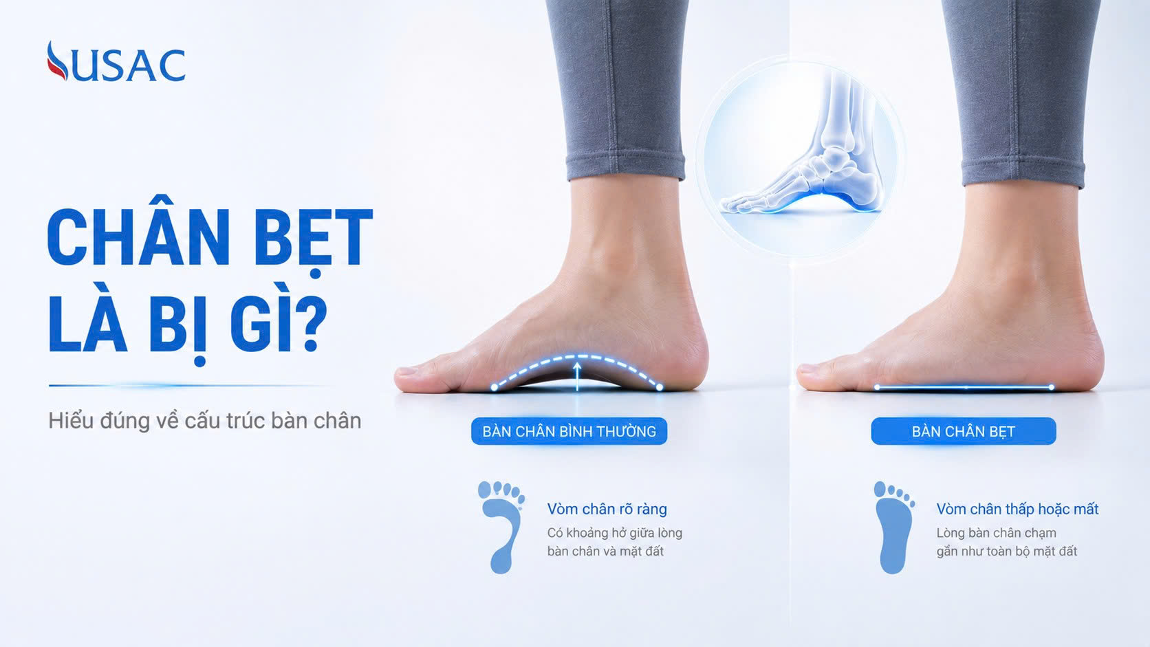 Chân Bẹt Là Bị Gì