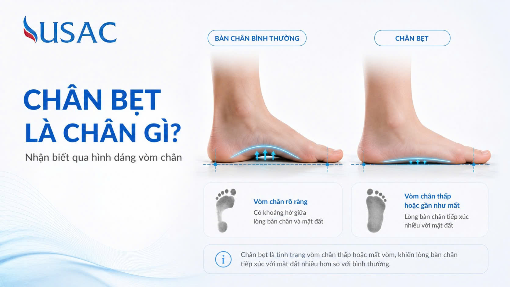Chân Bẹt Là Chân Gì Chân Bẹt Là Chân Gì