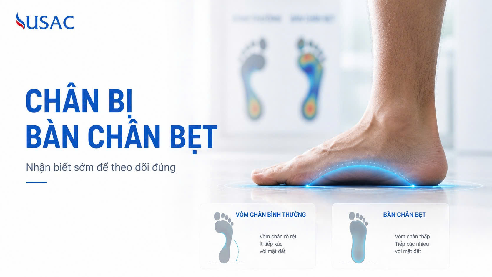 Chân Bị Bàn Chân Bẹt Chân Bị Bàn Chân Bẹt