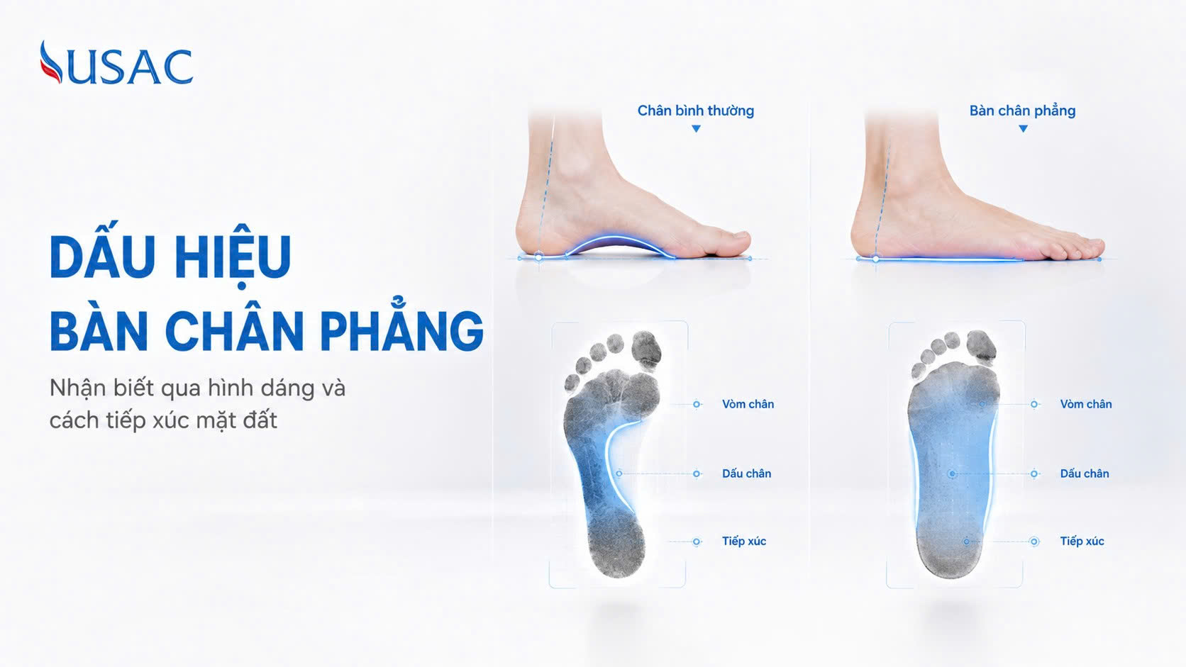 Dấu Hiệu Bàn Chân Phẳng Dấu Hiệu Bàn Chân Phẳng