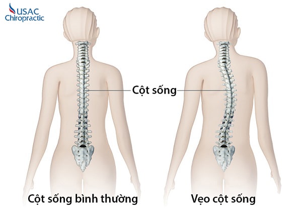 cong vẹo cột sống