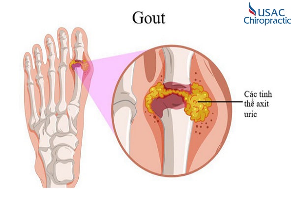 Chữa bệnh gout bằng các bài thuốc dân gian
