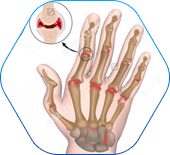 Joint degeneration and arthritis
