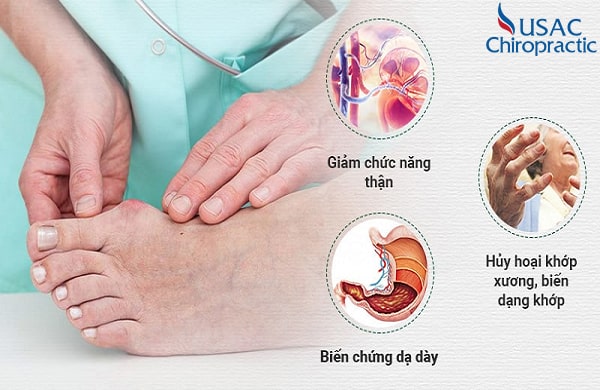 triệu chứng bệnh gout và cách điều trị
