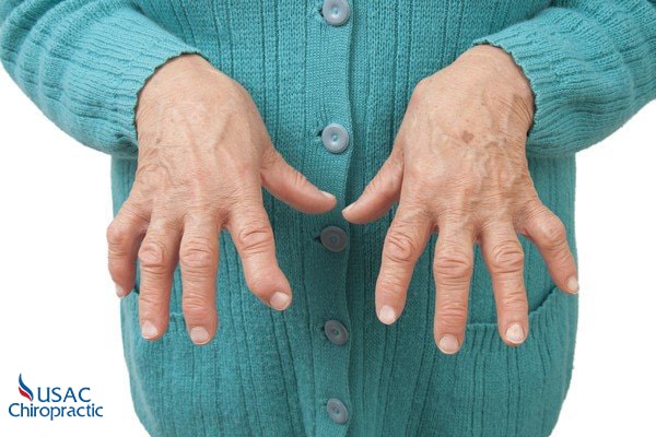 viêm khớp dạng thấp