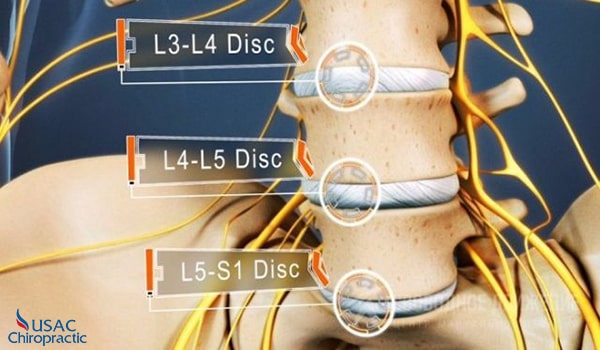 hẹp khe đĩa đệm l5 s1