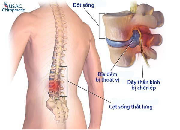 điều trị đau lưng không phẫu thuật
