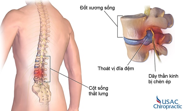thoái hóa đĩa đệm