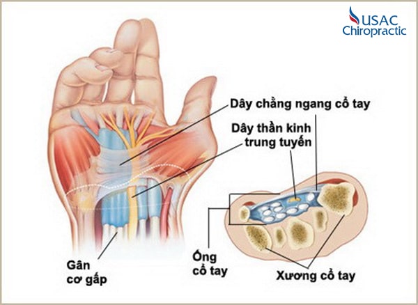 hội chứng ống cổ tay là gì