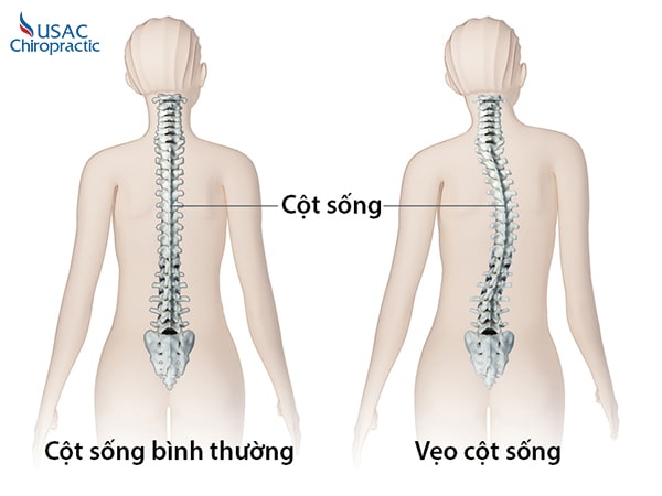 cách điều trị cong vẹo cột sống