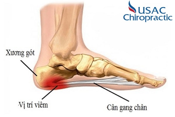 đau gót chân là bệnh gì