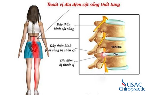 điều trị thoát vị đĩa đệm cột sống thắt lưng