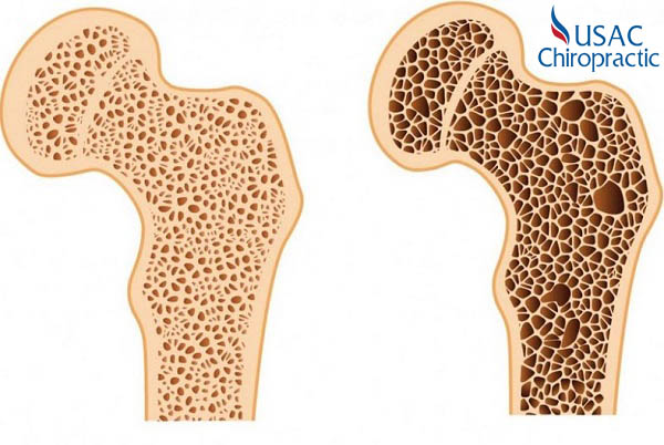 Tác dụng của cây mật gấu duy trì xương chắc khỏe, ngăn chặn sự thoái hóa các mô xương (loãng xương)