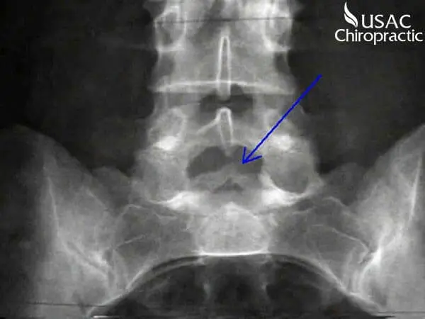 Gai đốt sống có thể gây ra nhiều vấn đề về sức khỏe cho người bệnh