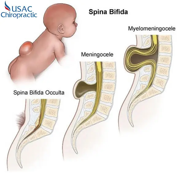 gai đốt sống s1 là căn bệnh bẩm sinh nhưng ngoài ra còn có nhiều nguyên nhân khác