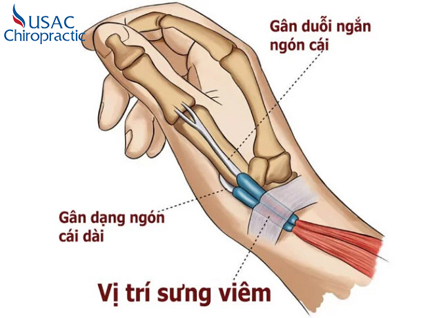Dù đóng vai trò quan trọng nhưng gân cổ tay là bộ phận rất dễ bị tổn thương