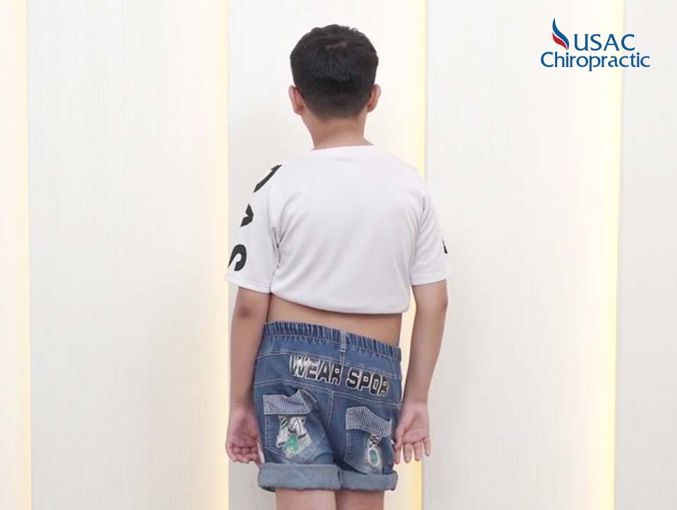 “CỞI BỎ” TỰ TI VẸO CỘT SỐNG CHO NAM SINH 14 TUỔI NHỜ PHÁC ĐỒ ĐỘC QUYỀN TỪ USAC CHIROPRACTIC