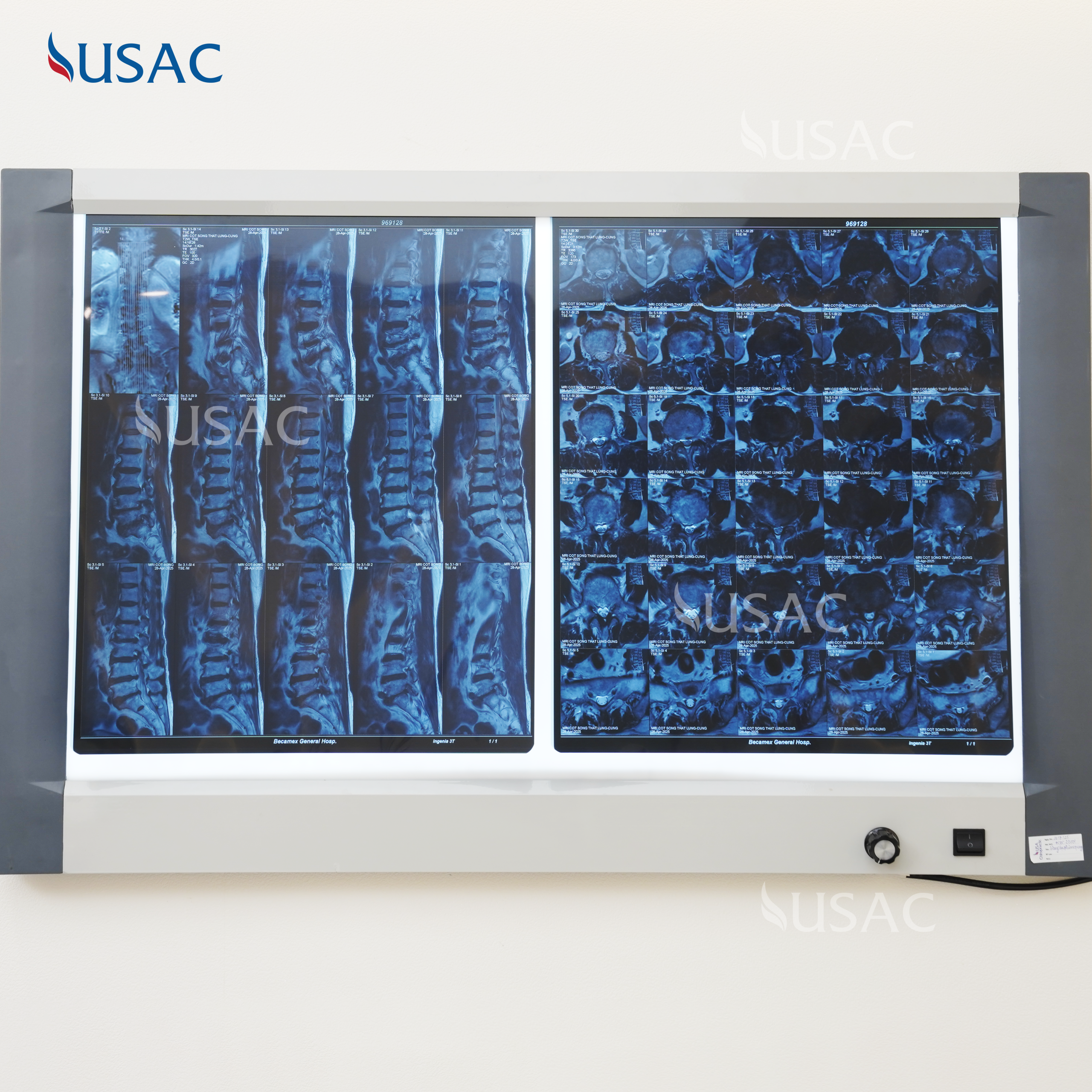 Film chụp cho thấy các đốt sống bị thoái hóa 