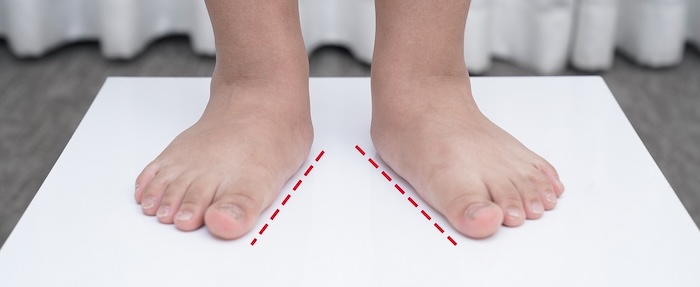 Bàn Chân Bằng Phẳng Bàn Chân Bằng Phẳng