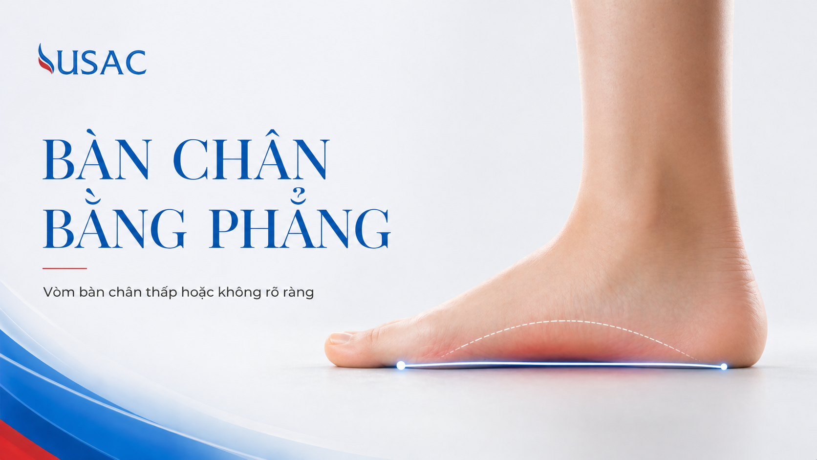 Bàn Chân Bằng Phẳng