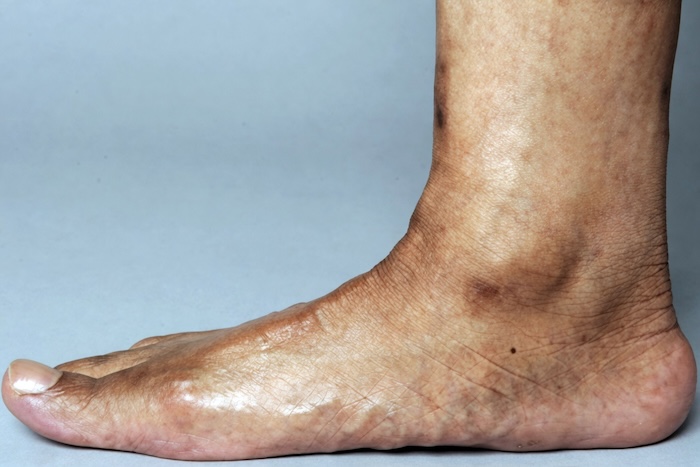 Bàn Chân Bằng Phẳng Có Ý Nghĩa Gì