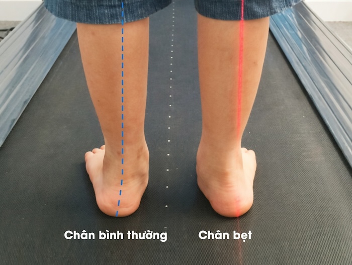 Bàn Chân Bẹt Ảnh Hưởng Như Thế Nào