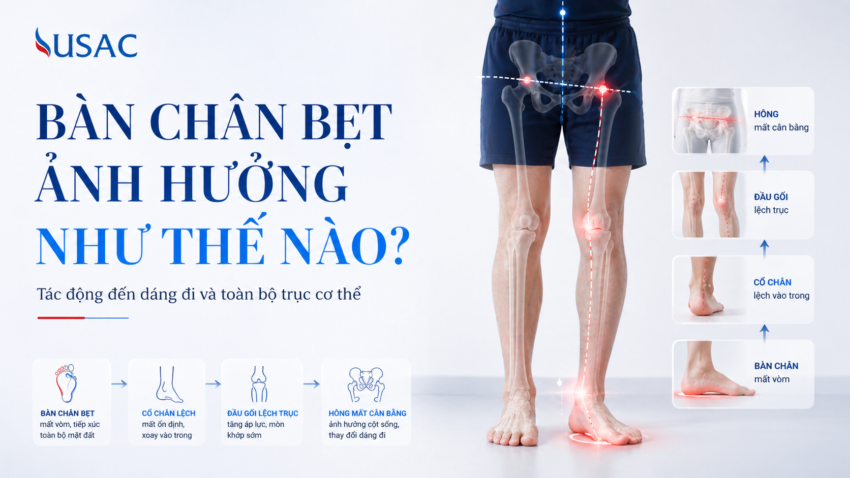 Bàn Chân Bẹt Ảnh Hưởng Như Thế Nào