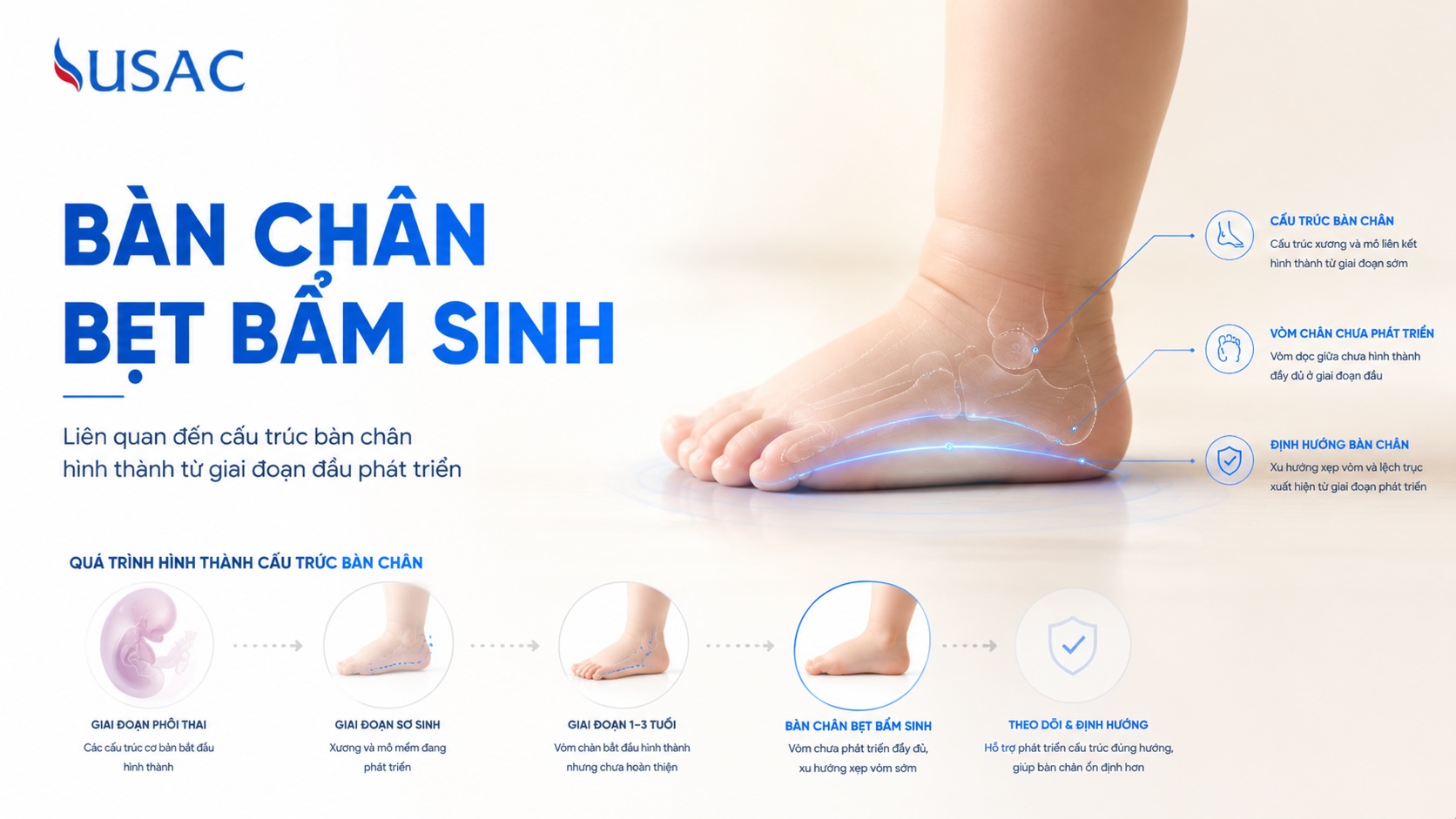 Bàn Chân Bẹt Bẩm Sinh