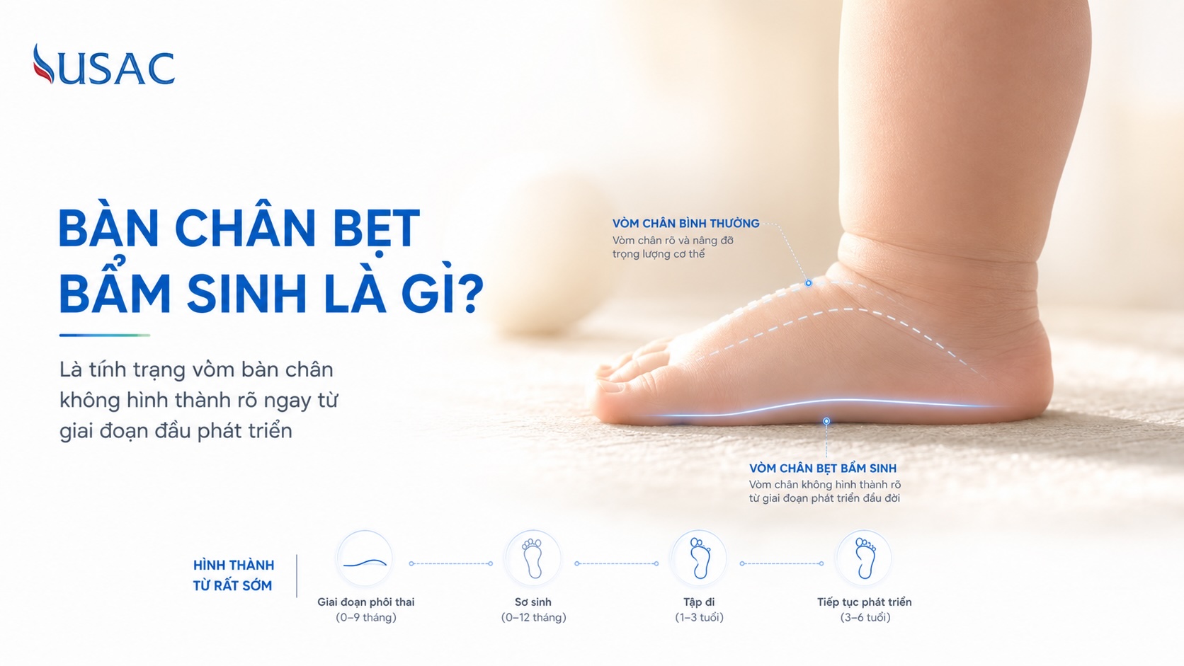 Bàn Chân Bẹt Bẩm Sinh Là Gì Bàn Chân Bẹt Bẩm Sinh Là Gì