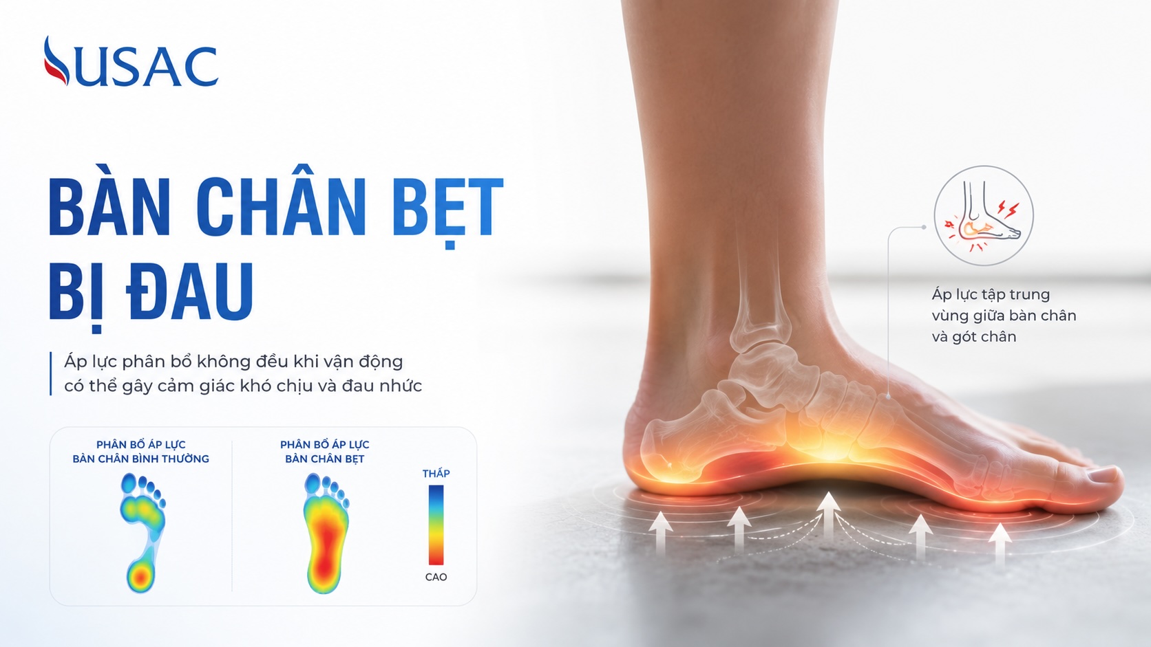 Bàn Chân Bẹt Bị Đau