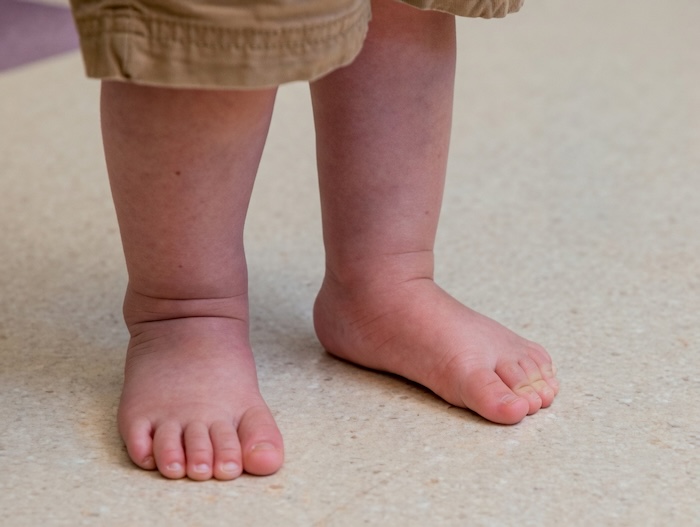 Bàn Chân Bẹt Có Phải Bẩm Sinh Không