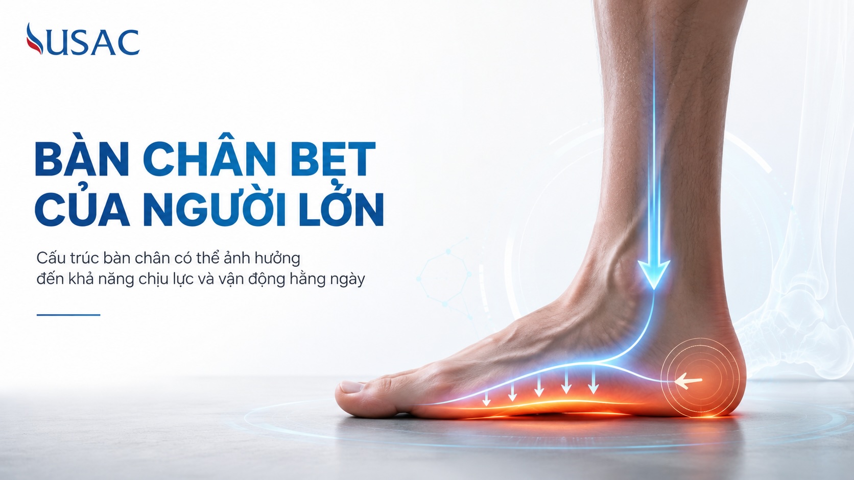 Bàn Chân Bẹt Của Người Lớn