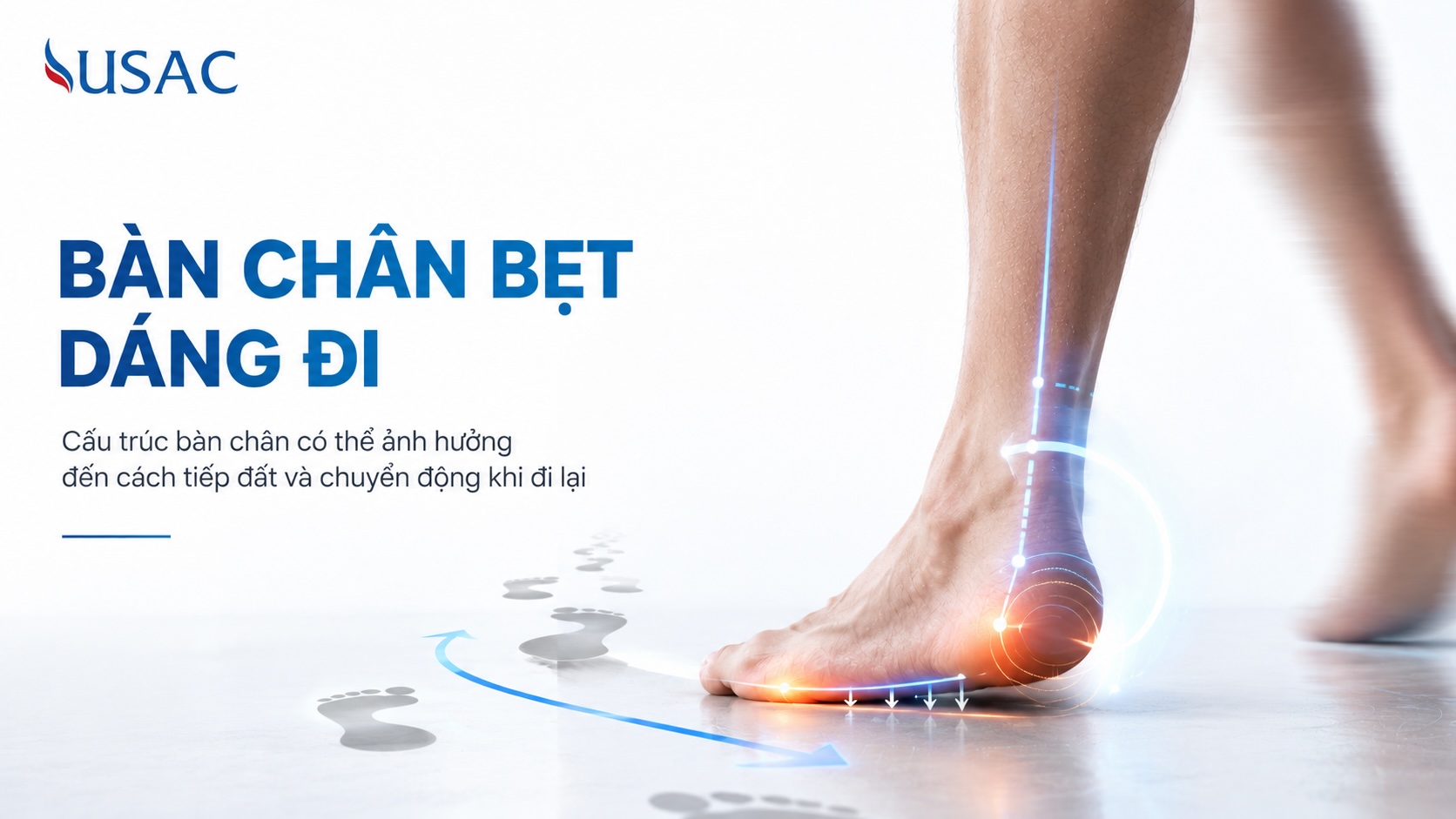 Bàn Chân Bẹt Dáng Đi