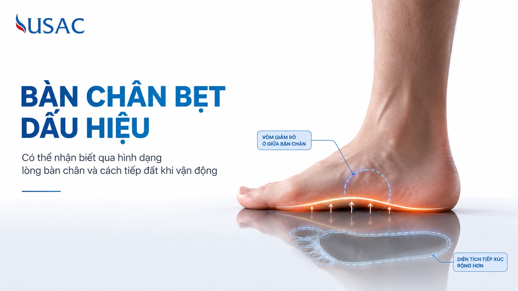Bàn Chân Bẹt Dấu Hiệu Bàn Chân Bẹt Dấu Hiệu