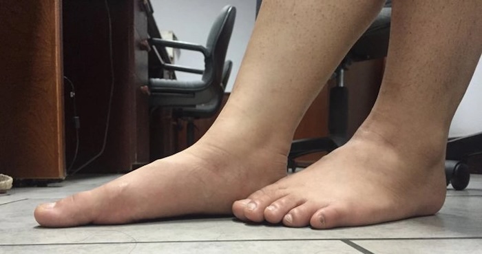 Bàn Chân Bẹt Đi Dép Gì