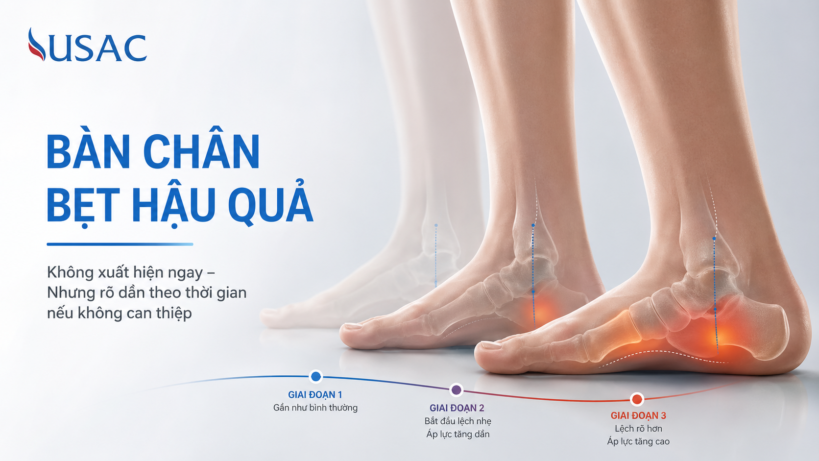 Bàn Chân Bẹt Hậu Quả