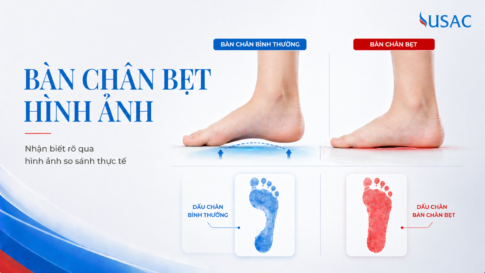 Bàn Chân Bẹt Hình Ảnh