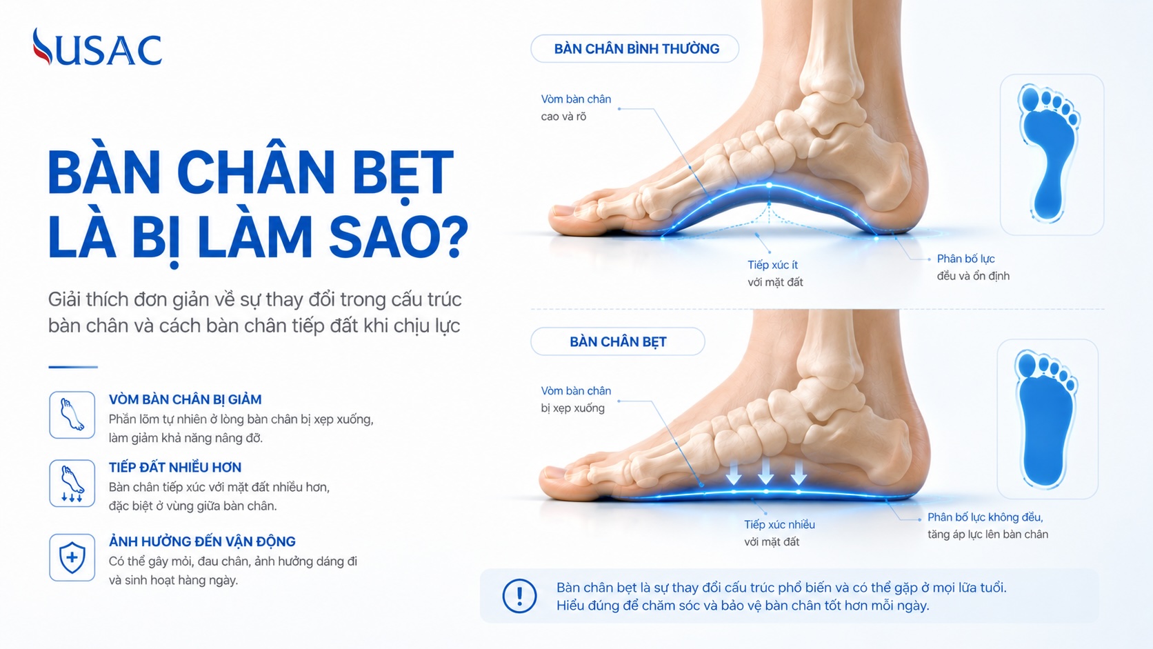 Bàn Chân Bẹt Là Bị Làm Sao