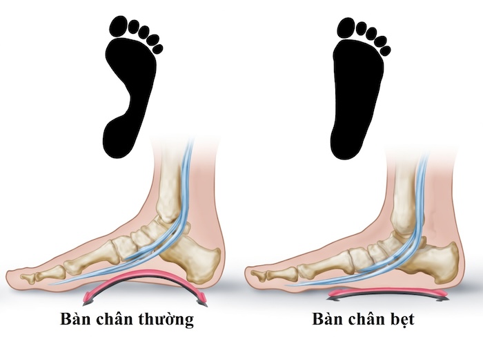 Bàn Chân Bẹt Mềm Bàn Chân Bẹt Mềm