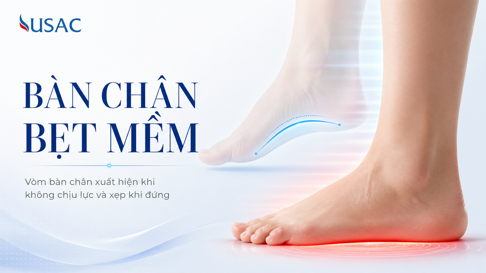 Bàn Chân Bẹt Mềm
