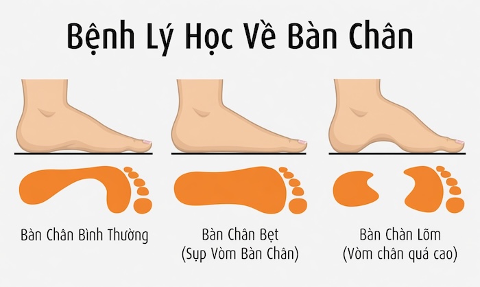 Bàn Chân Bẹt Mềm Là Gì
