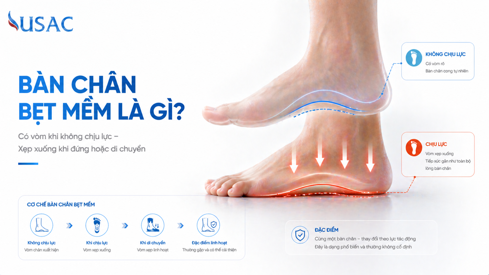 Bàn Chân Bẹt Mềm Là Gì Bàn Chân Bẹt Mềm Là Gì