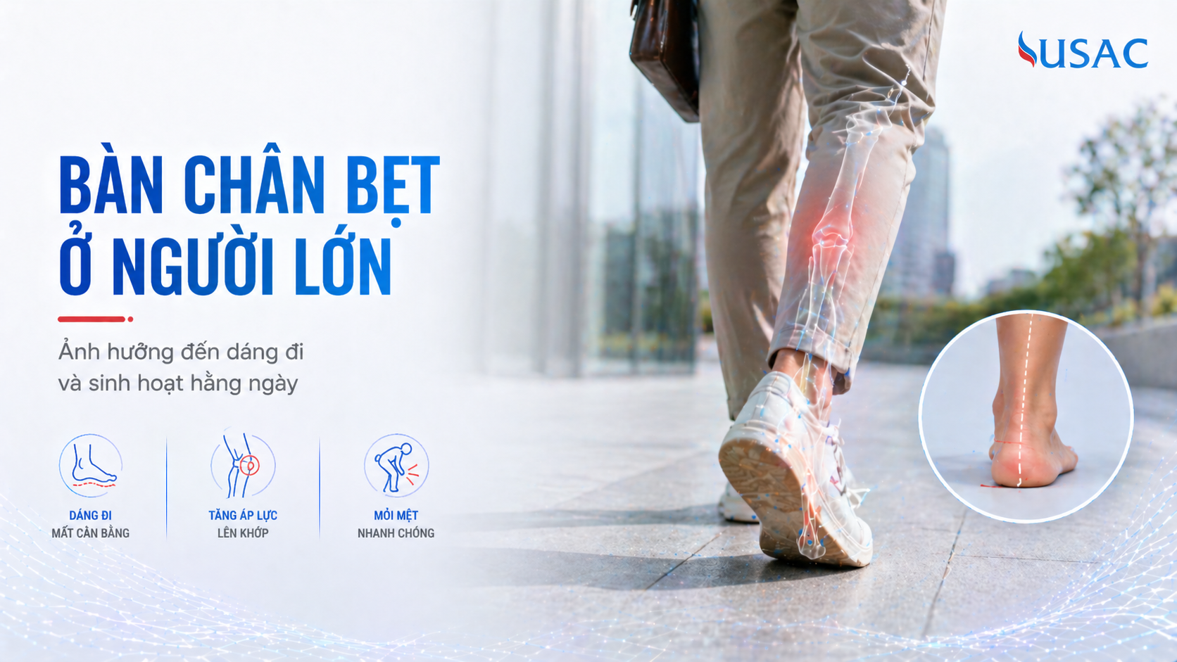 Bàn chân bẹt ở người lớn