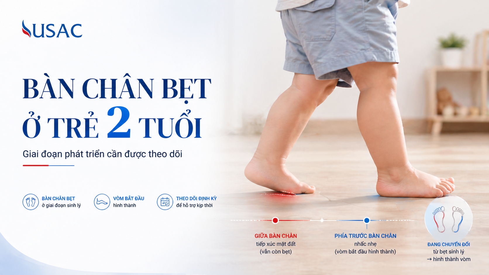 Bàn chân bẹt ở trẻ 2 tuổi Bàn chân bẹt ở trẻ 2 tuổi