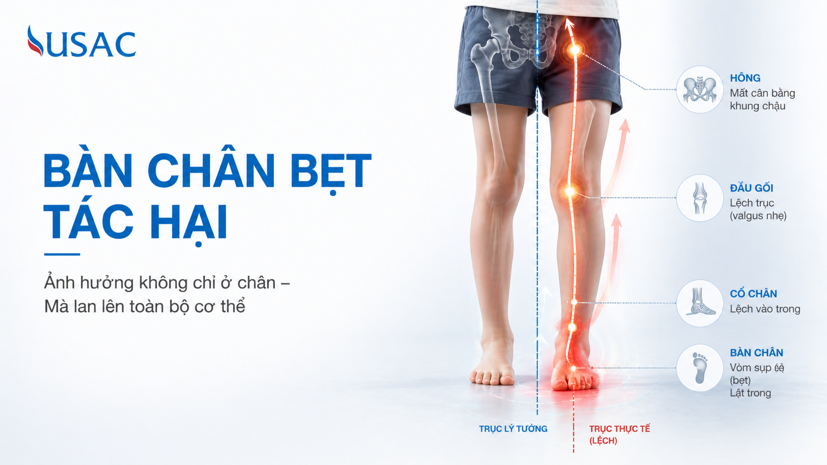 Bàn Chân Bẹt Tác Hại