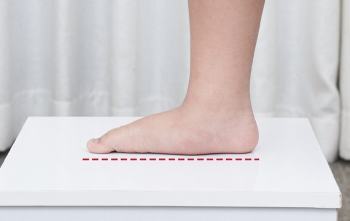 Bàn Chân Bẹt Thì Làm Sao