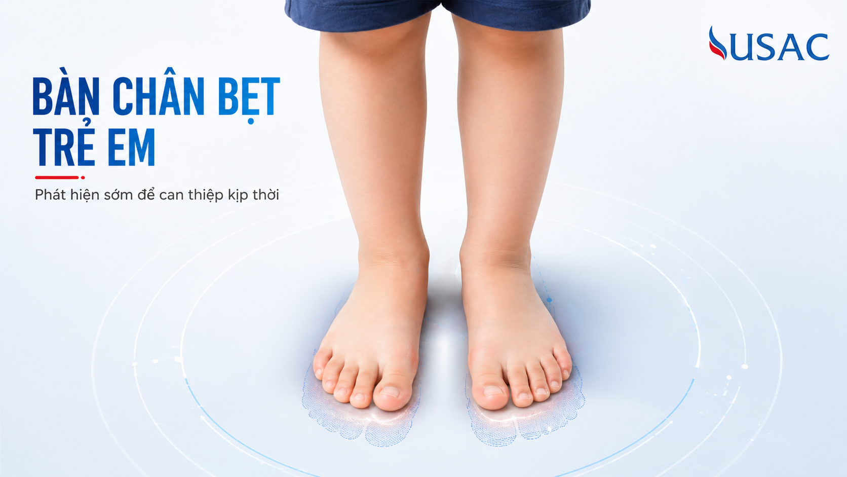 Bàn chân bẹt trẻ em Bàn chân bẹt trẻ em
