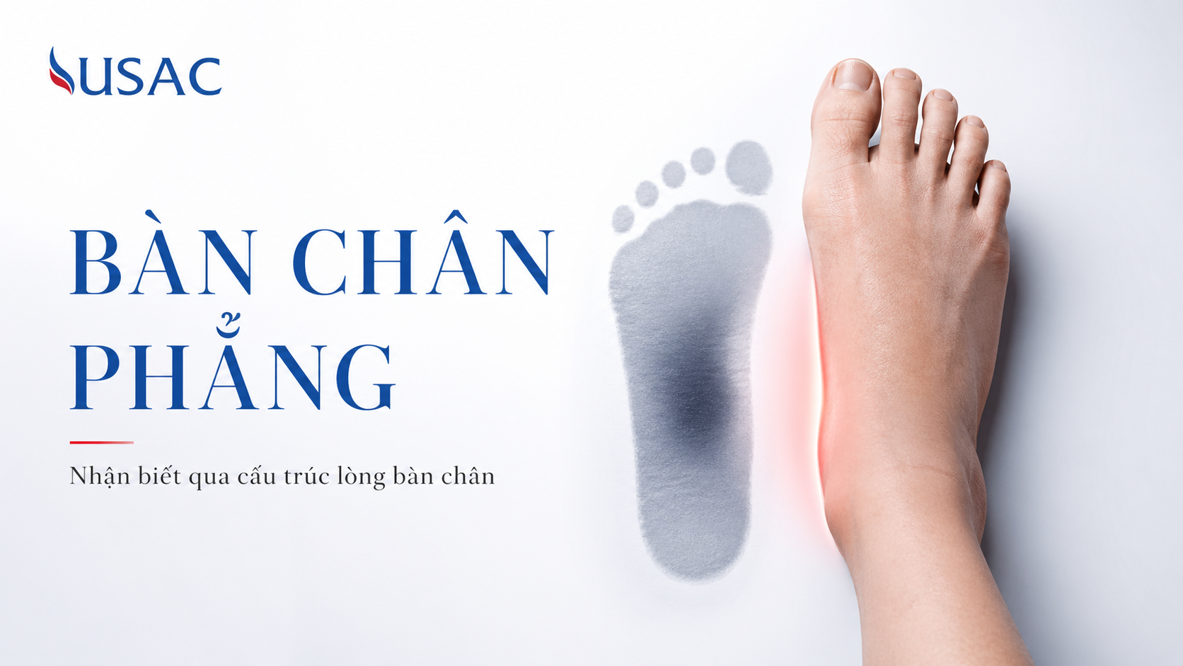 Bàn chân phẳng Bàn chân phẳng